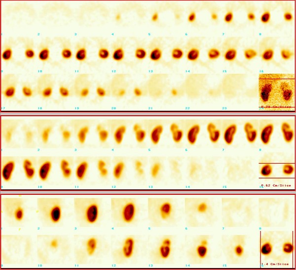 Obr. 4. SPECT ledvin.