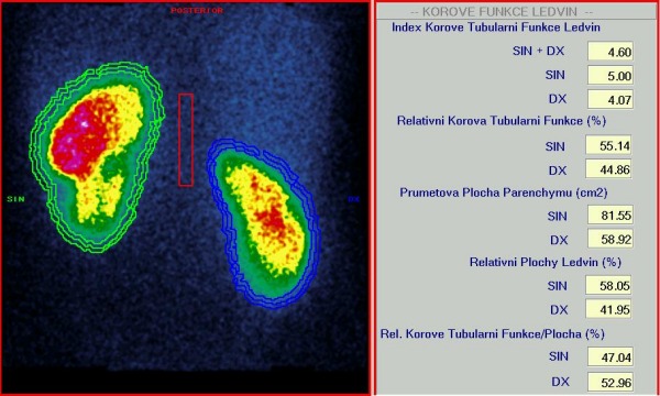 Obr. 3. Indexy korov tubulrn funkce a relativn korov tubulrn funkce.