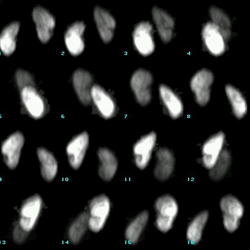 Obr. 8. SPECT, 3D rekonstrukce.