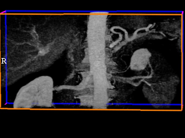 Obr. 2: CT angiografie abdominln aorty a renlnch tepen ve 3D zobrazen