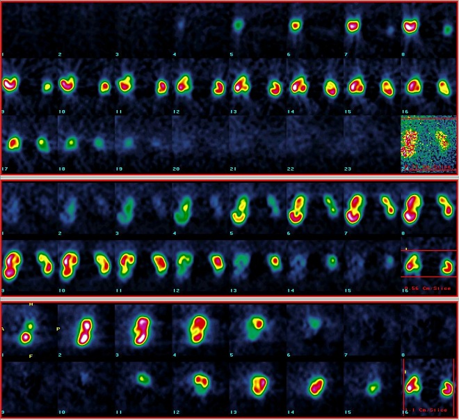 Obr. 3. SPECT ledvin