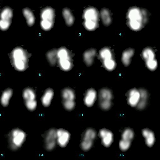 Obr. 7. SPECT, 3D rekonstrukce