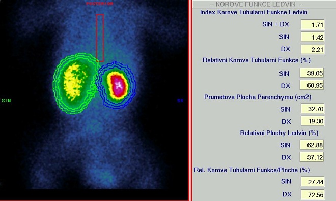 Obr. 1. Indexy korov tubulrn funkce a relativn korov tubulrn funkce.