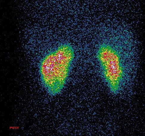 Obr. 2. Statick scintigrafie ledvin s 99mTc-DMSA, zadn projekce na 500 000 imp.