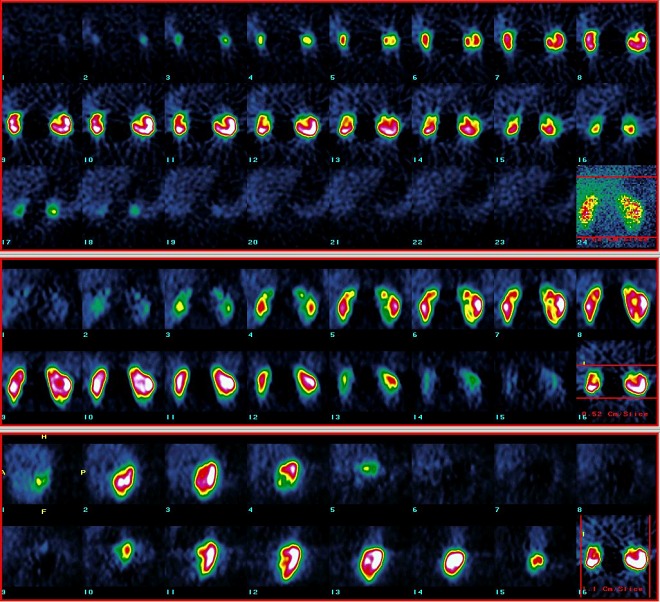 Obr. 3. SPECT ledvin