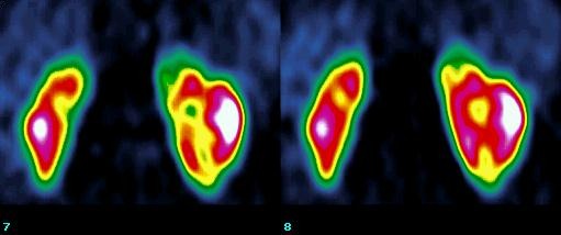 Obr. 4. SPECT, koronrn ezy