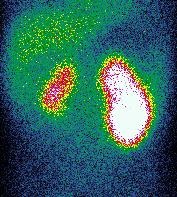 Obr. 2. Statick scintigrafie ledvin s 99mTc-DMSA, pedn projekce