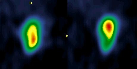 Obr. 7. SPECT, sagitln ezy prav ledviny