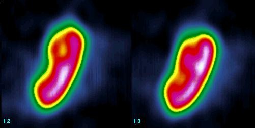 Obr. 8. SPECT, sagitln ezy lev ledviny