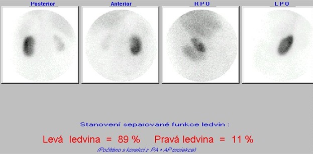 Obr. . 1: Statick scintigrafie ledvin v zadn, pedn a obou zadnch ikmch projekcch v poloze vlee