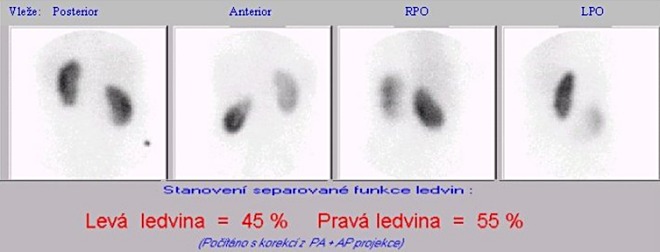 Obr. . 1: Statick scintigrafie ledvin v poloze vlee, v zadn projekci kobaltovm zdrojem oznaen heben prav kosti kyeln