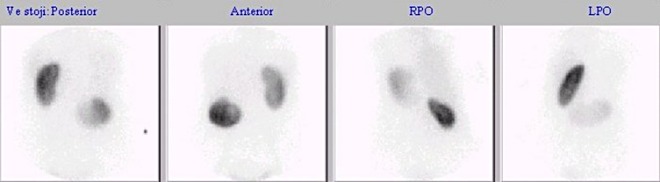 Obr. . 2: Statick scintigrafie ledvin v poloze ve stoje, v zadn projekci kobaltovm zdrojem oznaen heben prav kosti kyeln