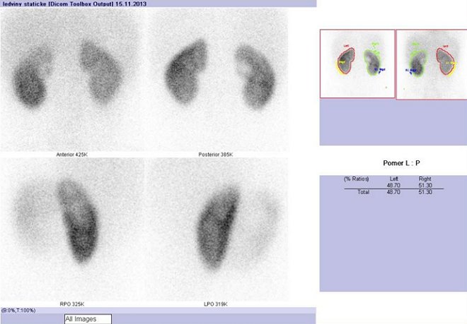 Obr. . 6: Statick scintigrafie ledvin v zadn, pedn a zadnch ikmch projekcch v poloze pacientky vlee s vsledky vpotu relativn funkce obou ledvin.