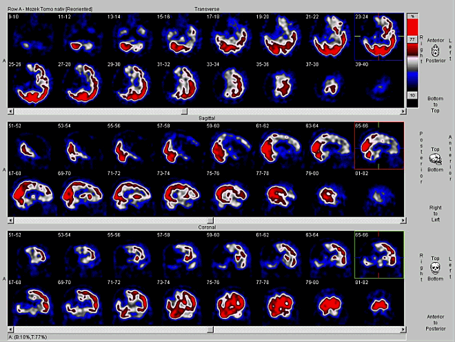 Obr. č. 1: SPECT mozku na dvouhlavé tomografické kameře.