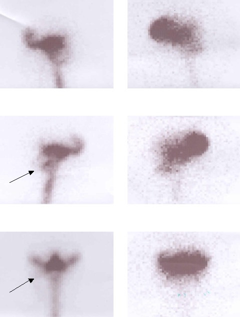 Obr. 1: Izotopová cisternografie pomocí 111In-DTPA