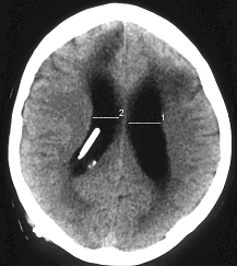 Obr. č. 2: CT mozku 29.7.2005 – patrné hypodenzní ložisko a rozšíření mozkových komor.