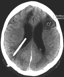 Obr. č. 4: CT mozku 3. 8. 2005 – patrné hypodenzní ložisko a již regredující hydrocefalus.