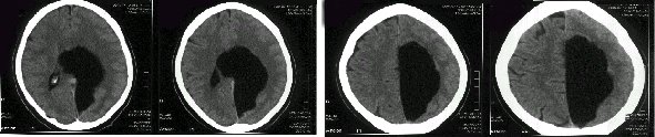 Obr. č. 1: CT hlavy: rozsáhlá cysta parietálně vlevo