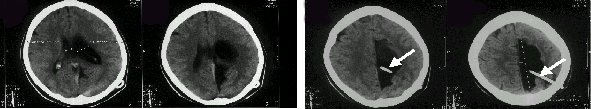 Obr. .4: CT po drenn operaci