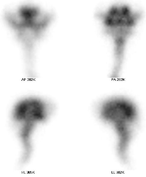 Obr. č. 1: Radionuklidová cisternografie – scintigrafie za 5 hod., nahoře přední a zadní projekce, dole pravá a levá boční projekce.