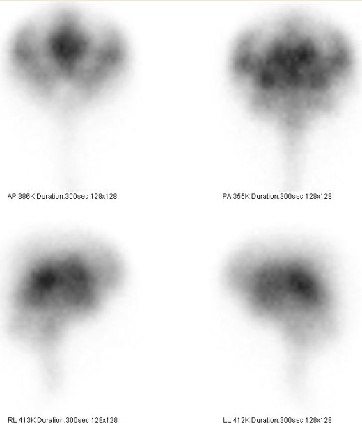 Obr. č. 2: Radionuklidová cisternografie –scintigrafie za 24 hod., nahoře přední a zadní, projekce, dole pravá a levá boční projekce.