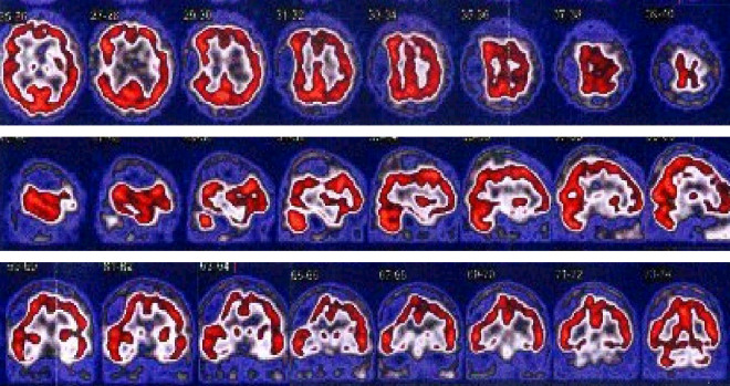 Obrzek . 1: SPECT mozku (vybran ezy) proveden po i.v. aplikaci 700 MBq prepartu 99mTc-HMPAO (prepart Neuroscan firmy ROTOP Pharmaka GmbH, SRN). Asymetrick zobrazen parietln oblasti imponuje jako zevn tlak expanzivnho procesu vpravo, drobn defekt perfuze v identick lokalizaci. Prvn ada jsou ezy v transverzln, druh v sagitln a tet v coronrn rovin