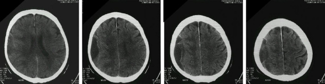 Obrázek č. 2: CT mozku (vybrané řezy) Vpravo parietálně pod kalvou útvar 92x30x30 mm, bez sycení postkontrastně, v okolí hyperdenzní lem, naznačeně septa uvnitř útvaru, zašlé subarachnoideální prostory na konvexitě vpravo. Závěr: chronický subdurální hematom vpravo parietálně