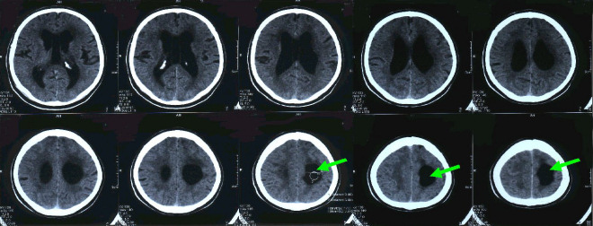 Obrázek č. 1: CT mozku (vybrané řezy): Dilatace komorového systému (III. komory i postranních komor), cysta parietálně vlevo komunikující s okcipitálním rohem levé postranní komory 2,5 x 3,5 x 4 cm zasahující vysoko pod kalvu (viz šipky). Hypodenzity kolem rohů postranních komor a lakuna v capsula interna vlevo. Gyrifikace je pravidelná. Známky cytotoxického edému v povodí ACM vpravo t.č. neprokázány.