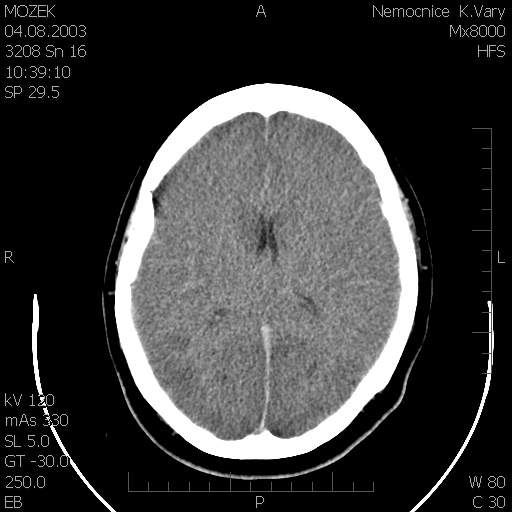 Obr. č. 1: CT mozku