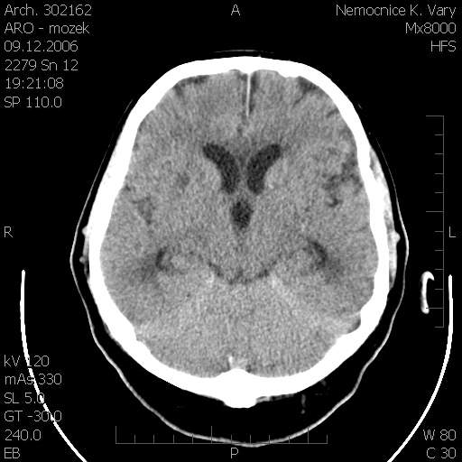 Obr. č. 6: CT mozku