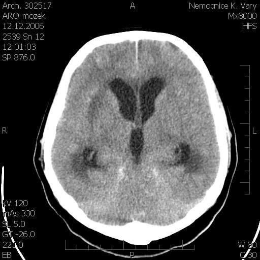 Obr. č. 7: CT mozku