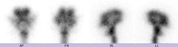 Obr. . 1: Radionuklidov cisternografie - scintigramy za 5 hod.