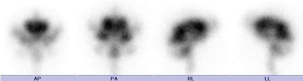 Obr. . 2: Radionuklidov cisternografie - scintigramy za 24 hod.