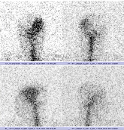 Obr. . 2: Radionuklidov cisternografie  scintigrafie za 8 hod.