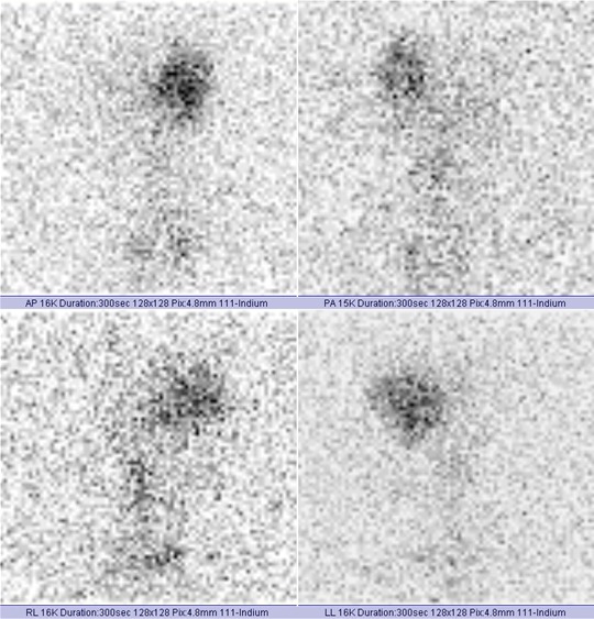 Obr. . 3: Radionuklidov cisternografie  scintigrafie za 24 hod.