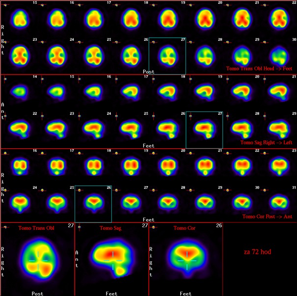 Obr.4.: nlez pi SPECT za 72 hod.