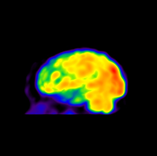 Obr.3.: 99mTc-HMPAO (ppravek Neuroscan) metodou SPECT