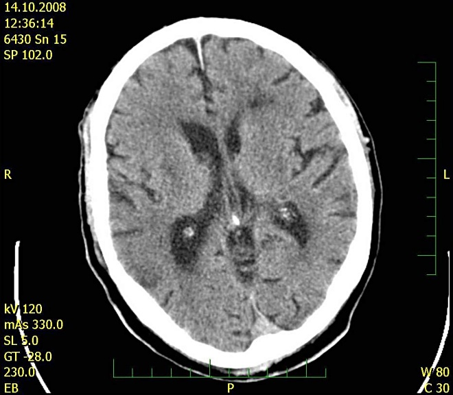 Obr. č. 1: CT mozku 14.10.2008
