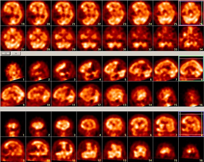 Obr. . 3: SPECT - defekt parietooccipitotemporln vpravo