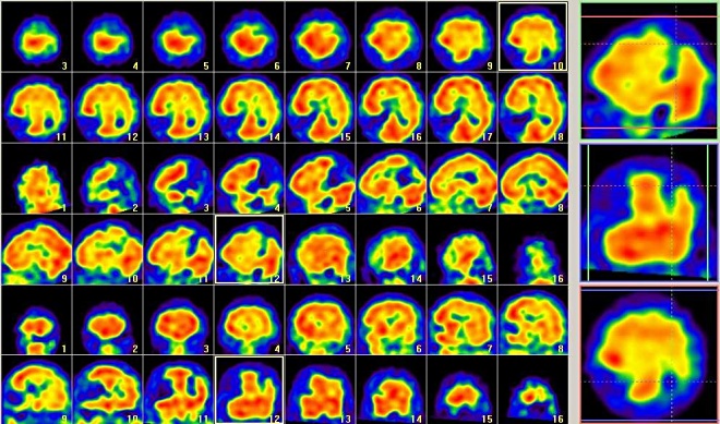 Obr. . 4: SPECT - defekt parietooccipitln vlevo