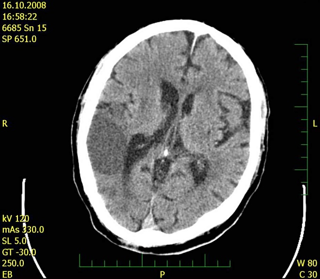 Obr. č. 5: CT mozku 16.10.2008