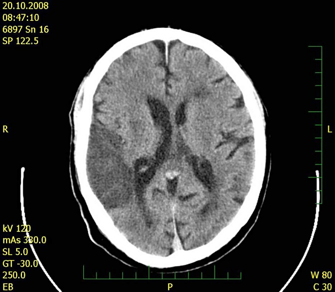 Obr. č. 6: CT mozku 20.10.2008