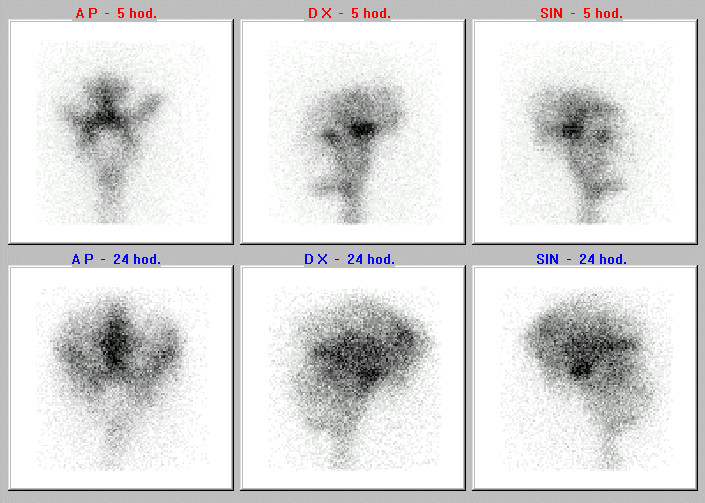 Obr. č. 1: Radionuklidová cisternografie – nahoře scintigramy za 5 hod., dole za 24 hod., vždy v přední, pravé a levé boční projekci