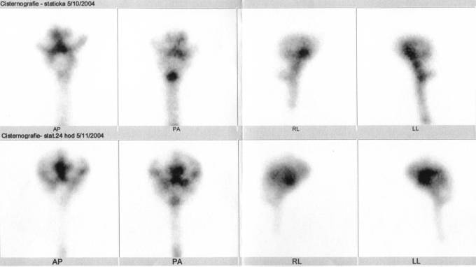 Obr. č. 2: Radionuklidová cisternografie – nahoře scintigramy za 5 hod., dole za 24 hod., vždy v přední, zadní, pravé a levé boční projekci