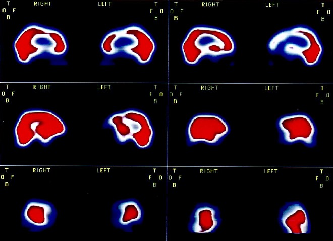 Obr. č. 2: SPECT mozku na jednohlavé tomografické kameře-sagitální řezy