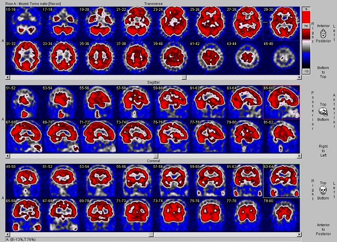 Obr. č. 1: SPECT mozku na dvouhlavé tomografické kameře
