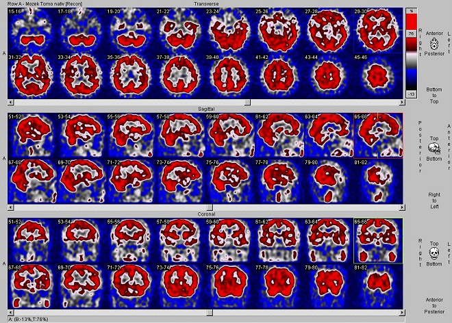Obr. č. 1: SPECT mozku na dvouhlavé tomografické kameře