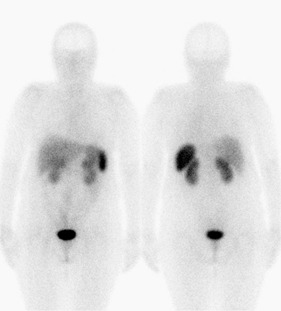 Obr. . 1: Celotlov scintigrafie v pedn a zadn projekci 4 hod. po aplikaci OctreoScanu