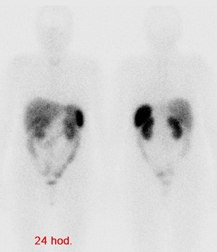 Obr. . 2: Celotlov scintigrafie v pedn a zadn projekci 24 hod. po inj. OctreoScanu