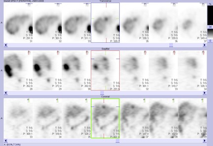 Obr. . 3: Tomografick scintigrafie jater 24 hod. po aplikaci OctreoScanu.